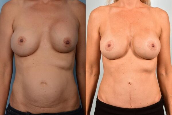 Revision Breast Surgery 12