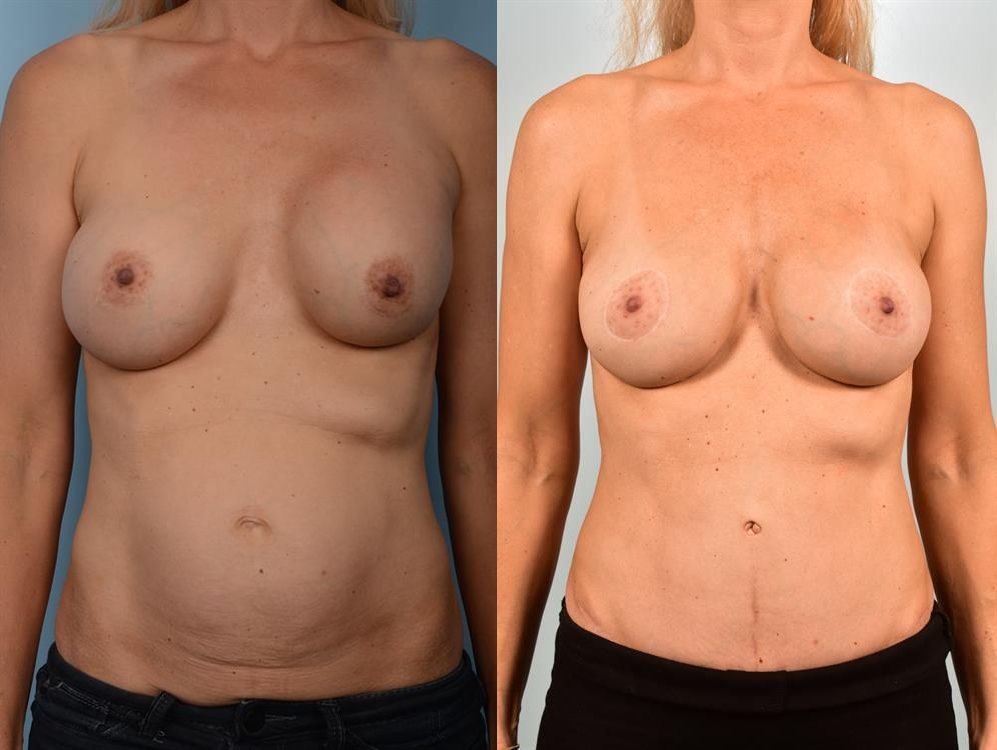 Revision Breast Surgery 12