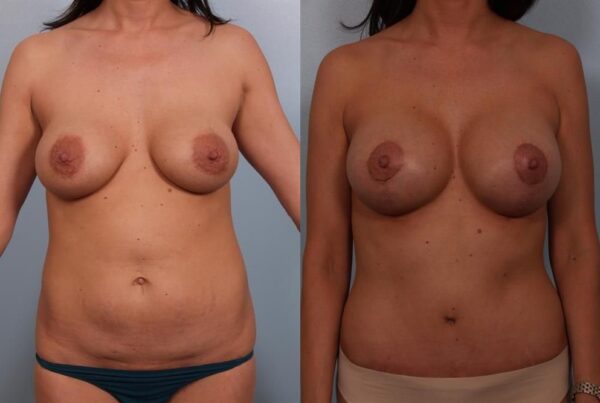 Revision Breast Surgery 13