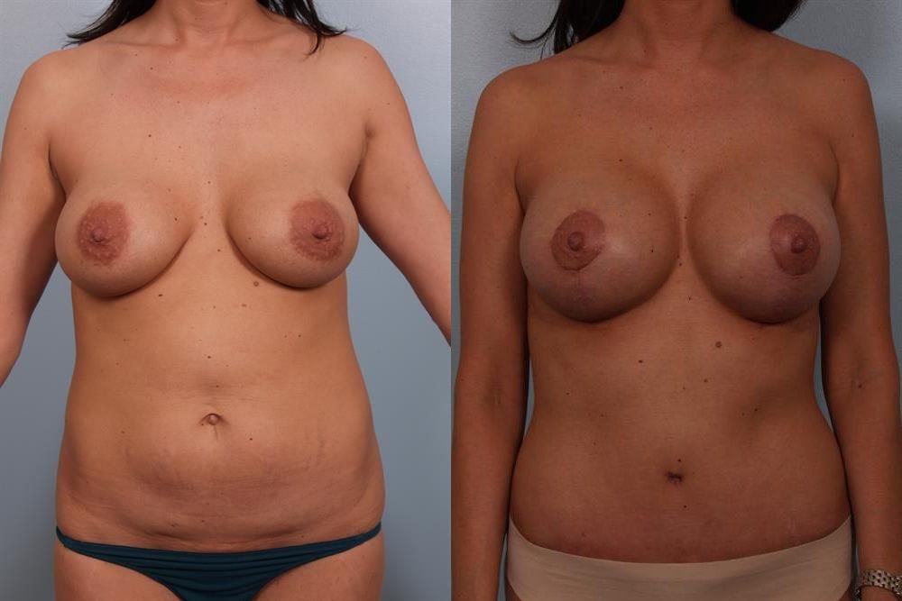 Revision Breast Surgery 13