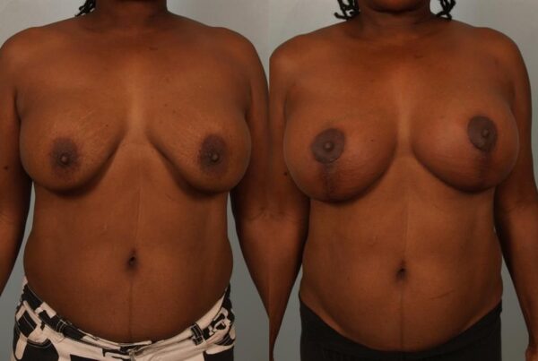 Revision Breast Surgery 14