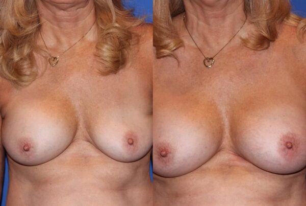 Revision Breast Surgery 15