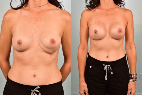 Revision Breast Surgery 16
