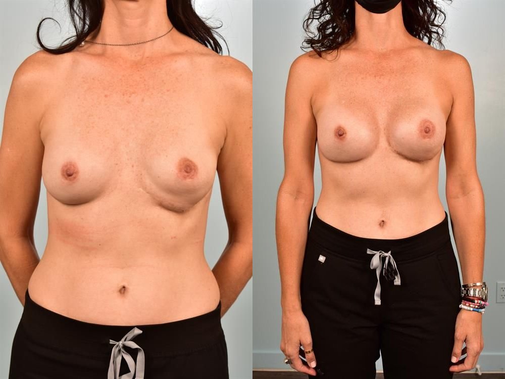 Revision Breast Surgery 16