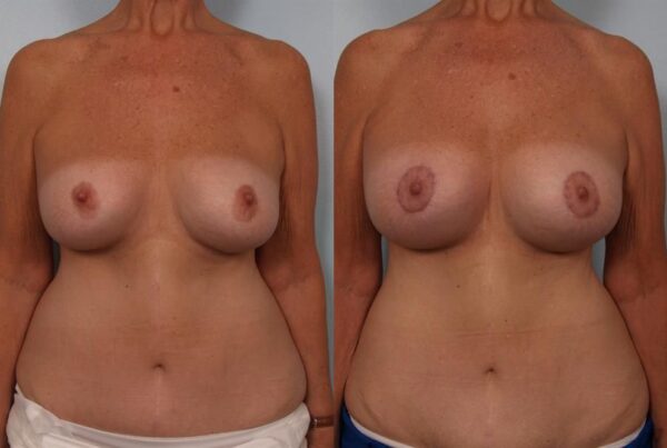 Revision Breast Surgery 17