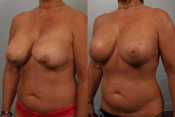 Revision Breast Surgery 18