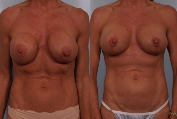 Revision Breast Surgery 2