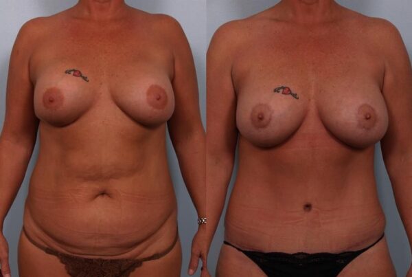 Revision Breast Surgery 20