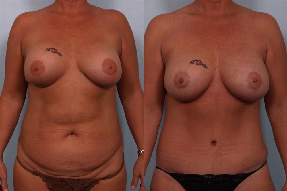 Revision Breast Surgery 20