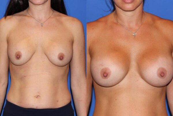 Revision Breast Surgery 21