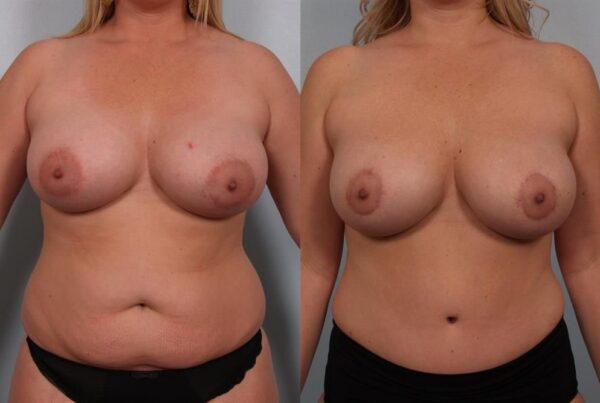 Revision Breast Surgery 22