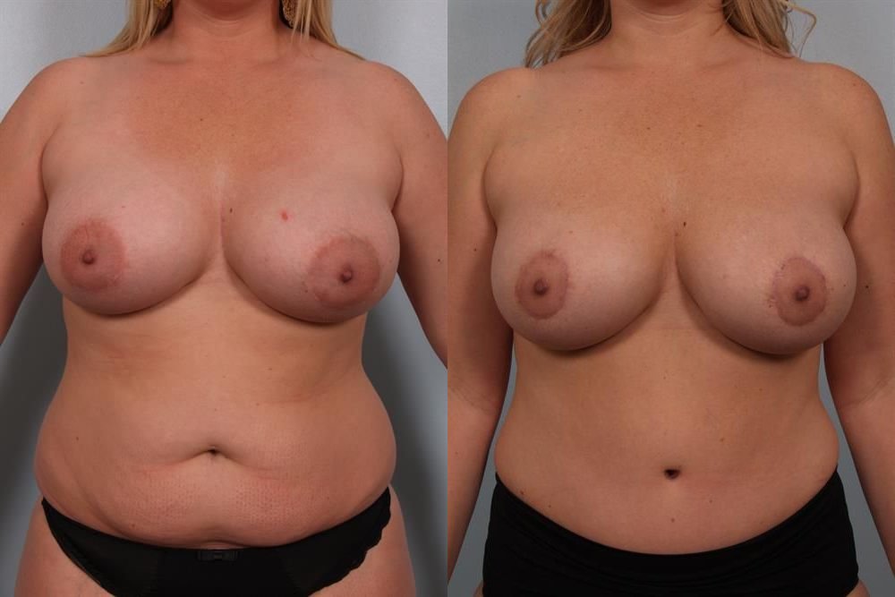 Revision Breast Surgery 22