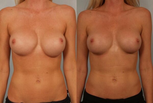 Revision Breast Surgery 23