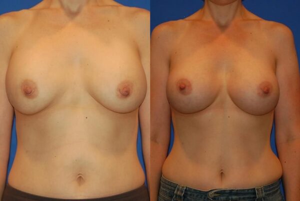 Revision Breast Surgery 24