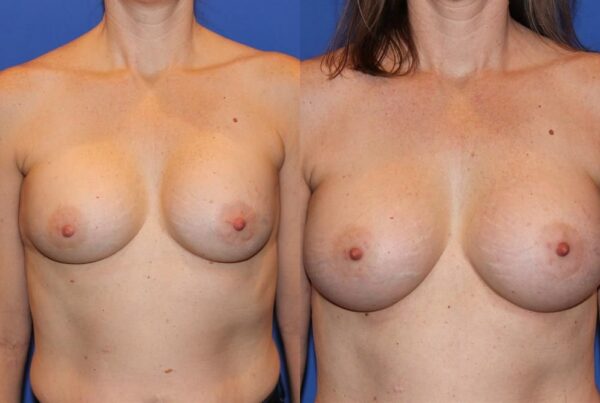 Revision Breast Surgery 25