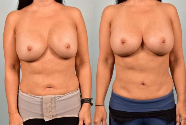 Revision Breast Surgery 26