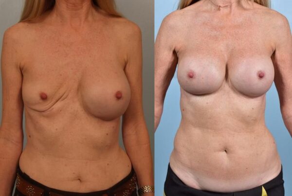 Revision Breast Surgery 27