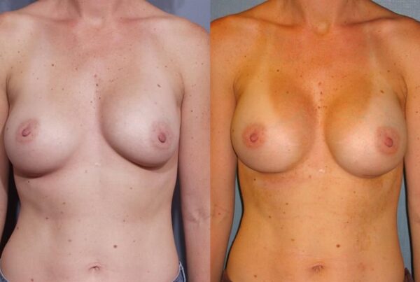Revision Breast Surgery 28