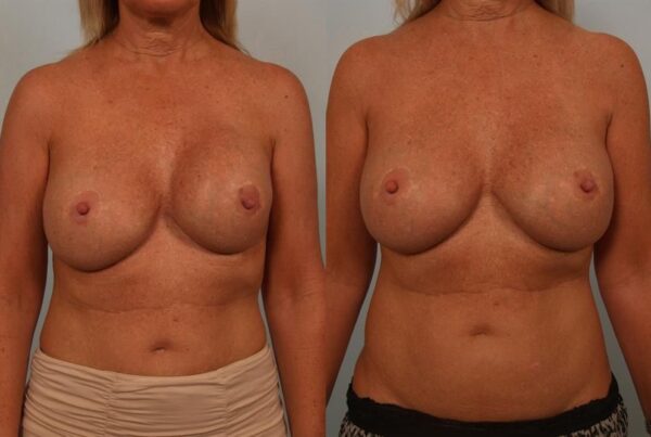 Revision Breast Surgery 29
