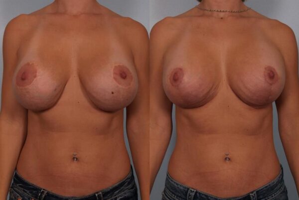 Revision Breast Surgery 30