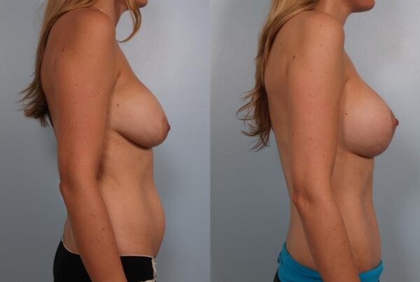 Revision Breast Surgery 32