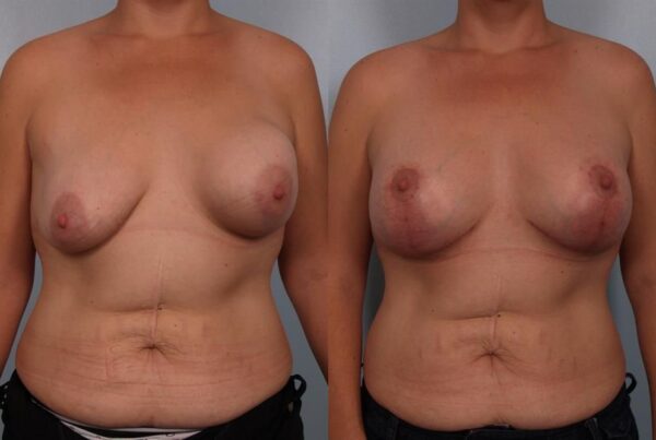 Revision Breast Surgery 33