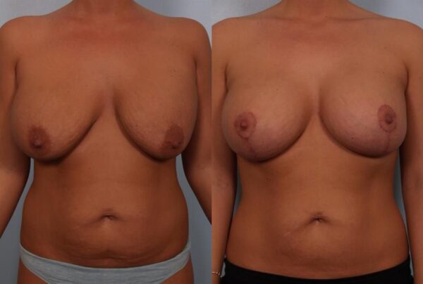 Revision Breast Surgery 34