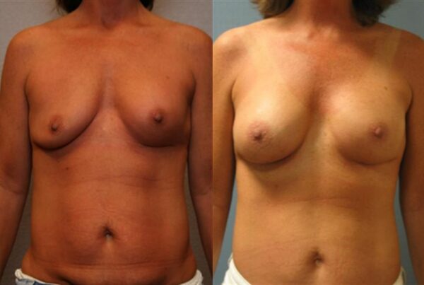 Revision Breast Surgery 35