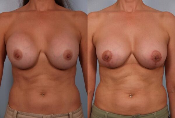 Revision Breast Surgery 36