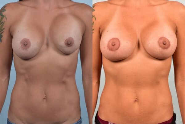 Revision Breast Surgery 37