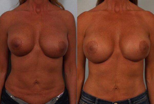 Revision Breast Surgery 38