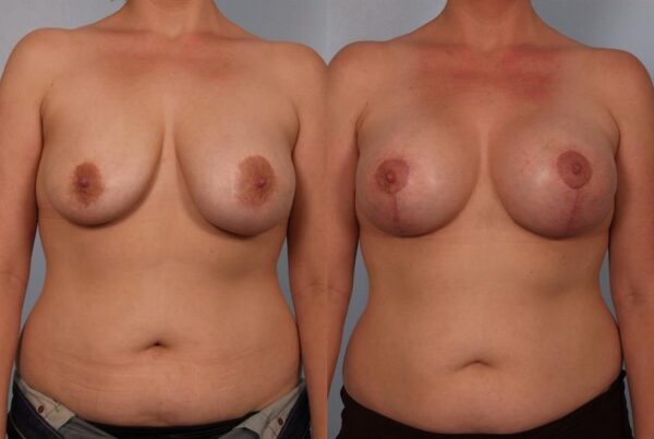 Revision Breast Surgery 39