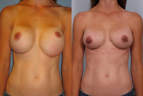 Revision Breast Surgery 4