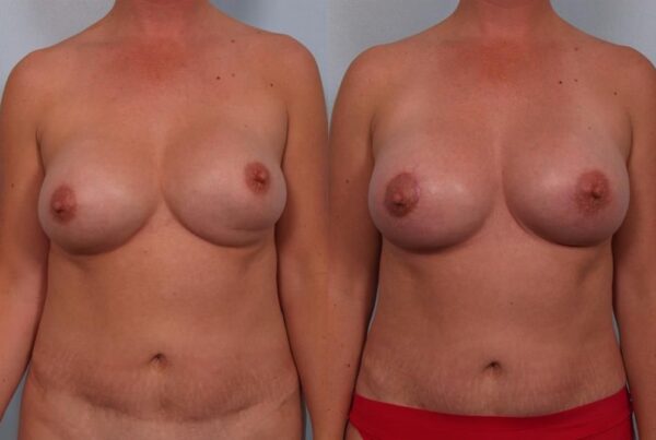 Revision Breast Surgery 5