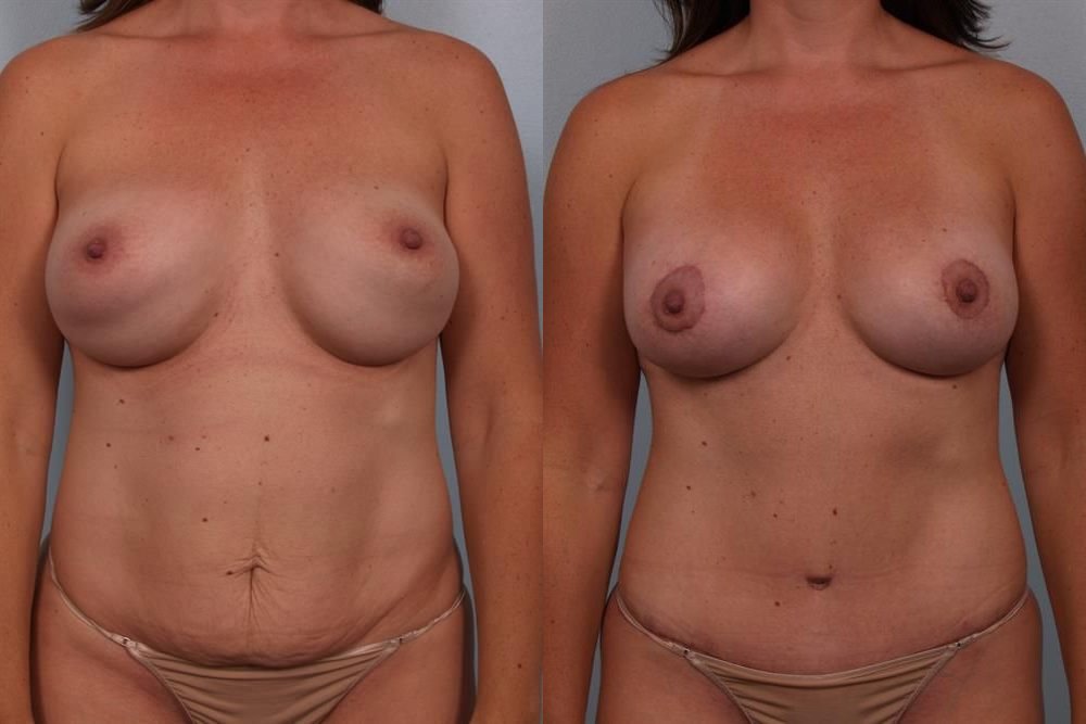 Revision Breast Surgery 6
