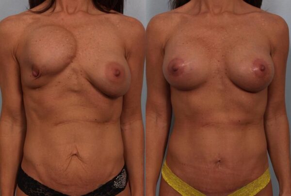 Revision Breast Surgery 7