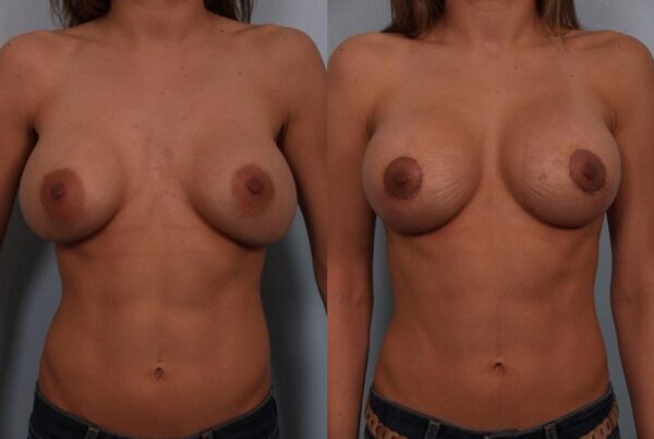 Revision Breast Surgery 8