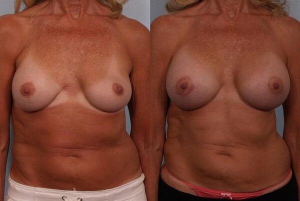Revision Breast Surgery 9