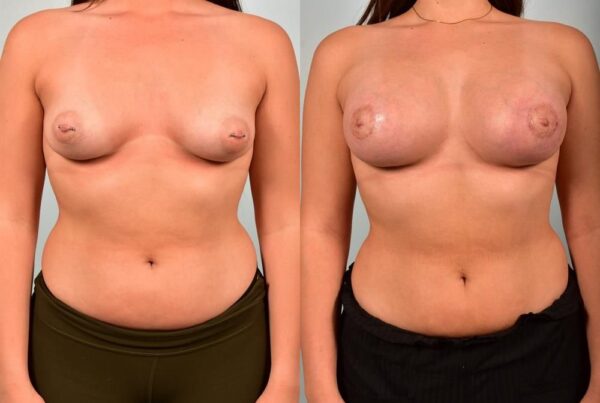 Sub-Fascial Breast Augmentation 1