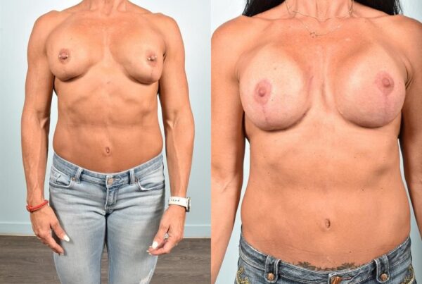 Sub-Fascial Breast Augmentation 10