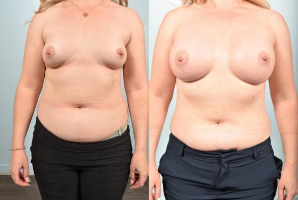 Sub-Fascial Breast Augmentation 11