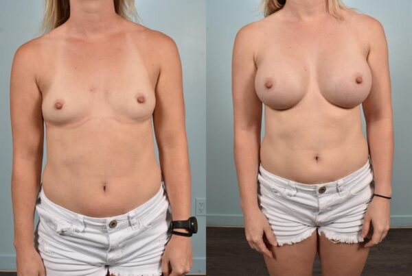 Sub-Fascial Breast Augmentation 12