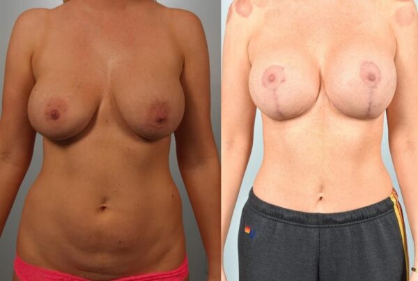 Sub-Fascial Breast Augmentation 15