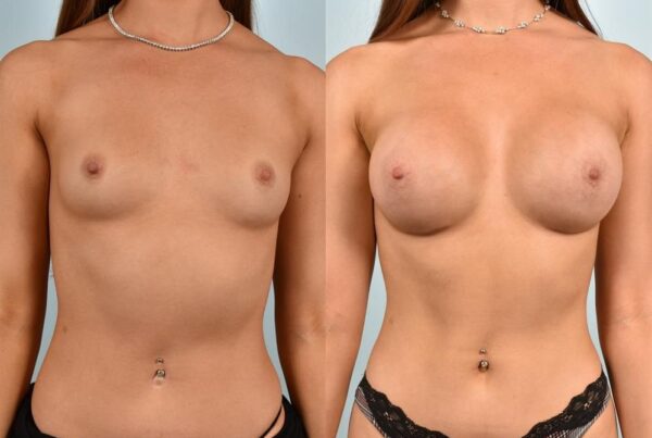 Sub-Fascial Breast Augmentation 16