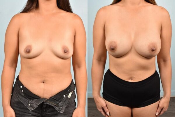 Sub-Fascial Breast Augmentation 19