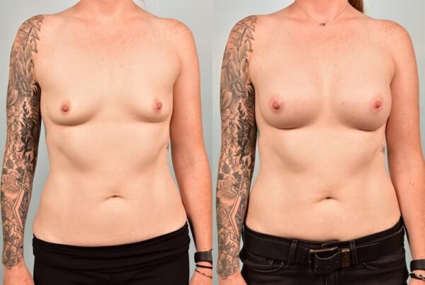 Sub-Fascial Breast Augmentation 2