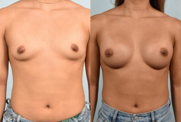 Sub-Fascial Breast Augmentation 20