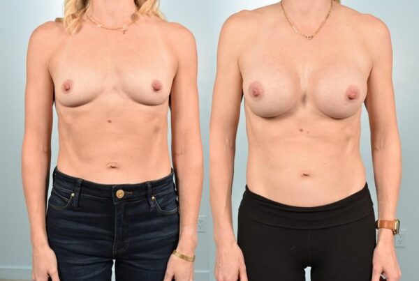 Sub-Fascial Breast Augmentation 21