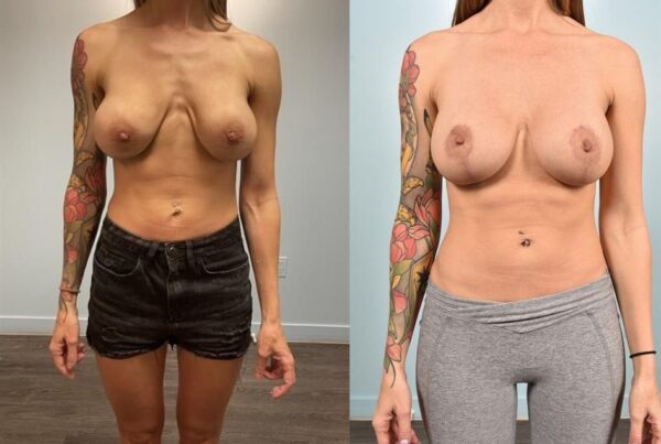 Sub-Fascial Breast Augmentation 22