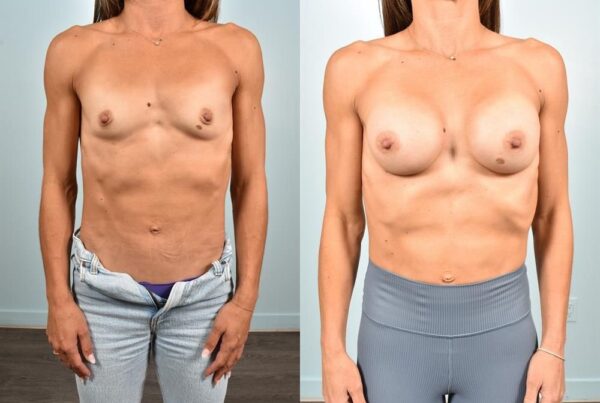 Sub-Fascial Breast Augmentation 23